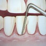 歯周病の検査は何を調べるの？